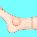 Dagadt, ödémás boka