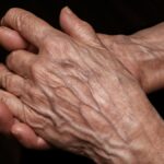 Kidudorodó vénák a kézen – mikor ártalmatlan, és mikor figyelmeztető jel
